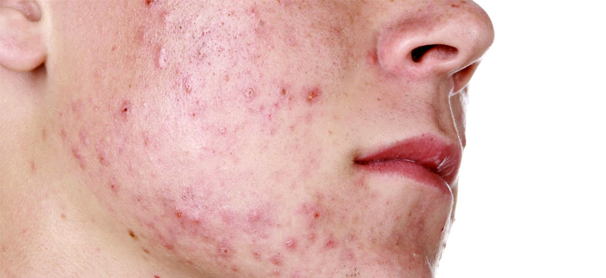 Acné | R&amp;Z Dermatech