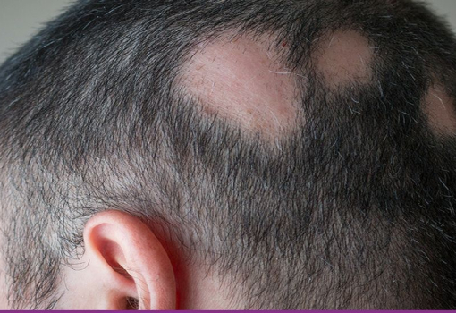 Alopecia Areata