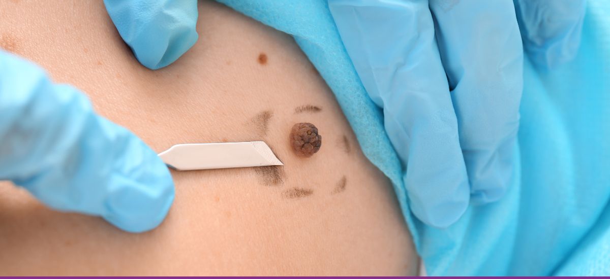 Cáncer de Piel