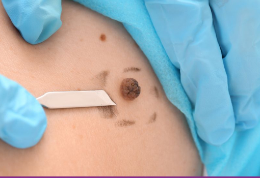 Cáncer de Piel
