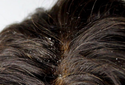 Dermatitis Seborréica (Caspa)