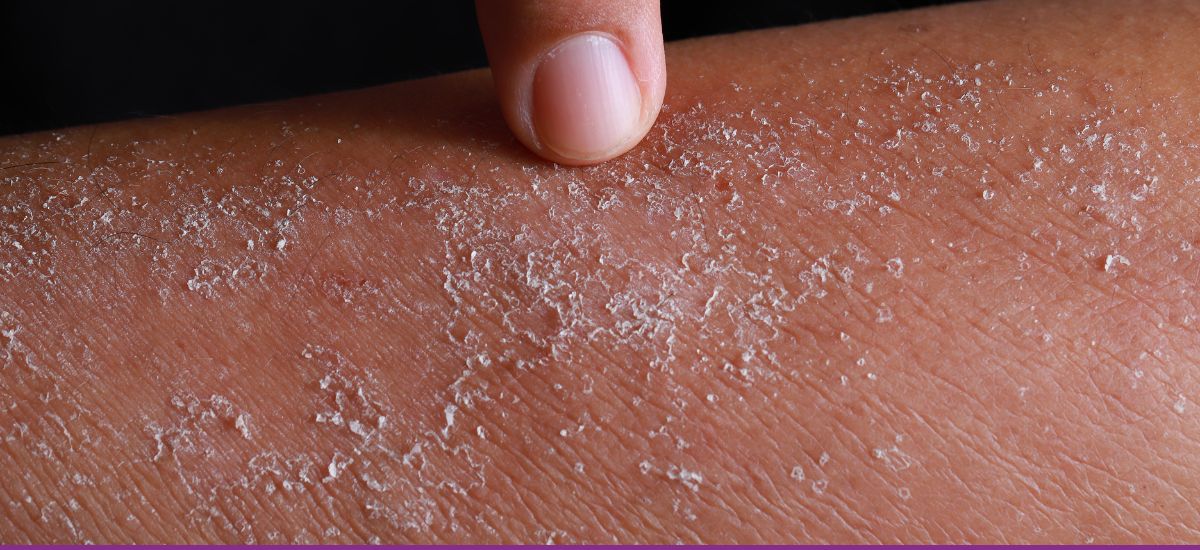 Dermatitis de Contacto