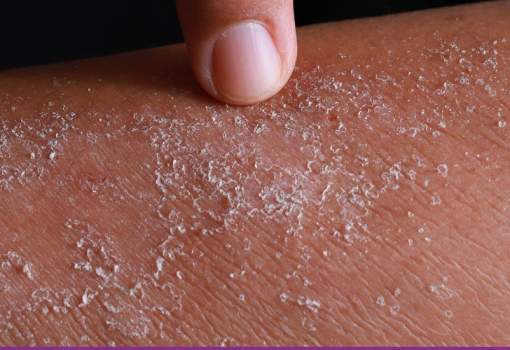 Dermatitis de Contacto
