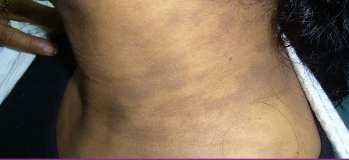 Dermatitis de Contacto