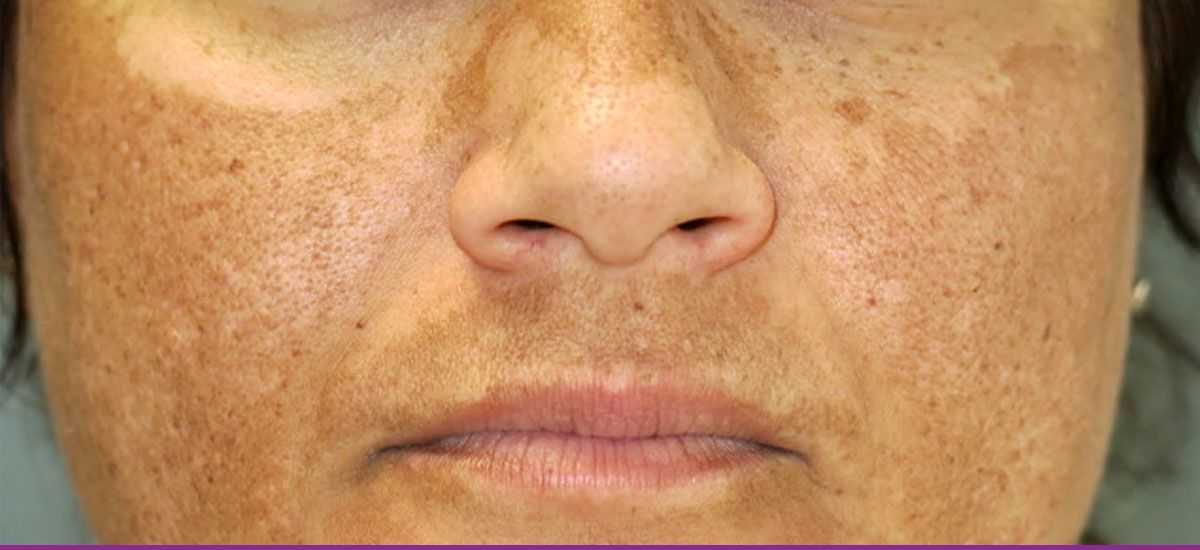 Dermatitis de Contacto