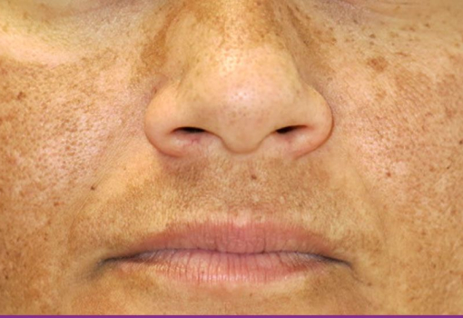Melasma