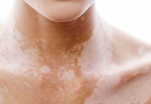 Vitiligo