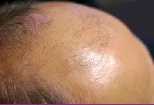 Alopecia Androgenética