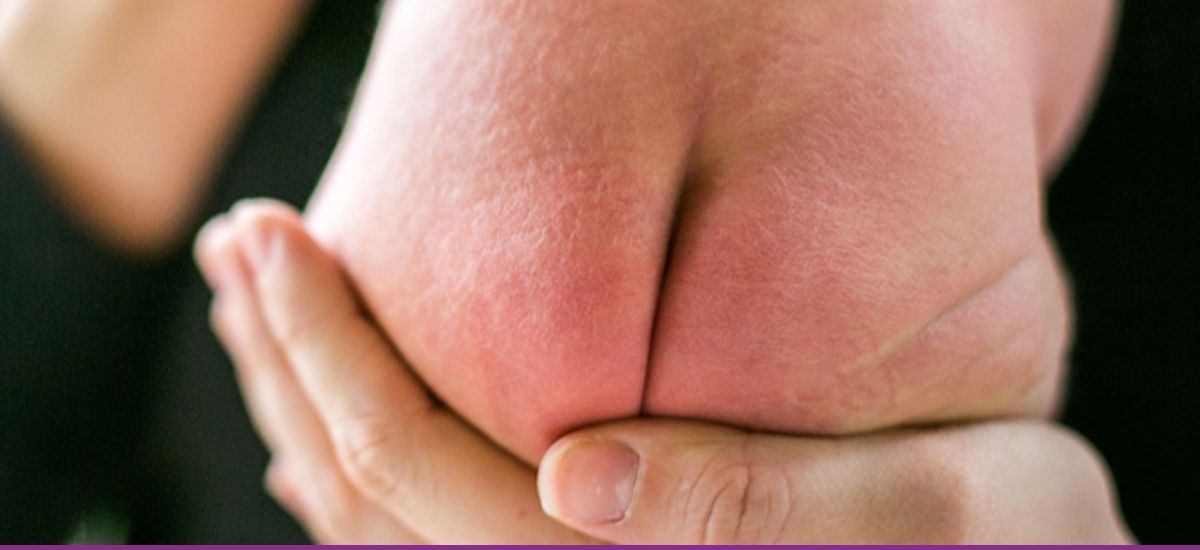 Dermatitis del Pañal