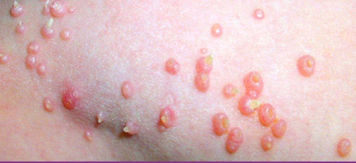 Molusco Contagioso