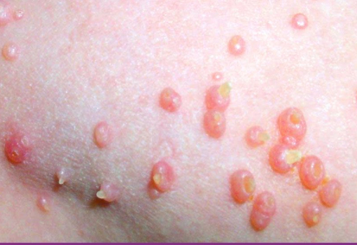 Molusco Contagioso