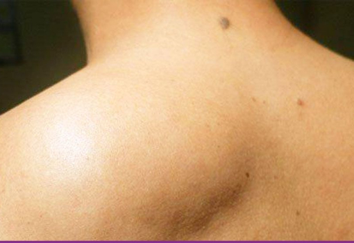 Lipoma
