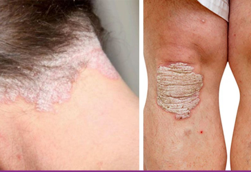 Psoriasis