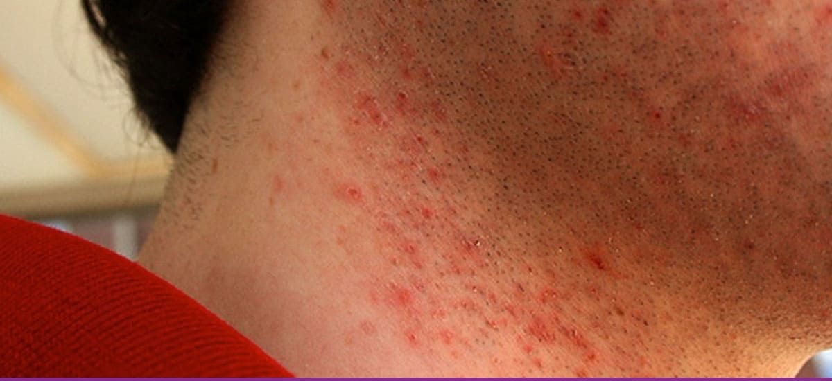 Foliculitis