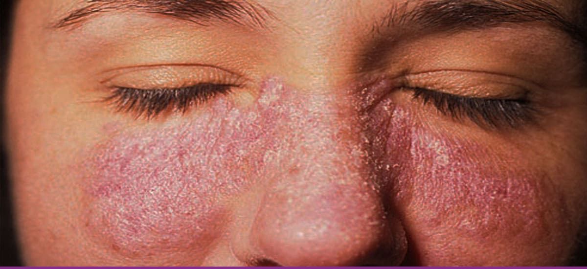 Lupus Eritematoso Discoide