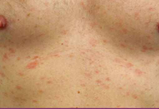 Pitiriasis Rosada