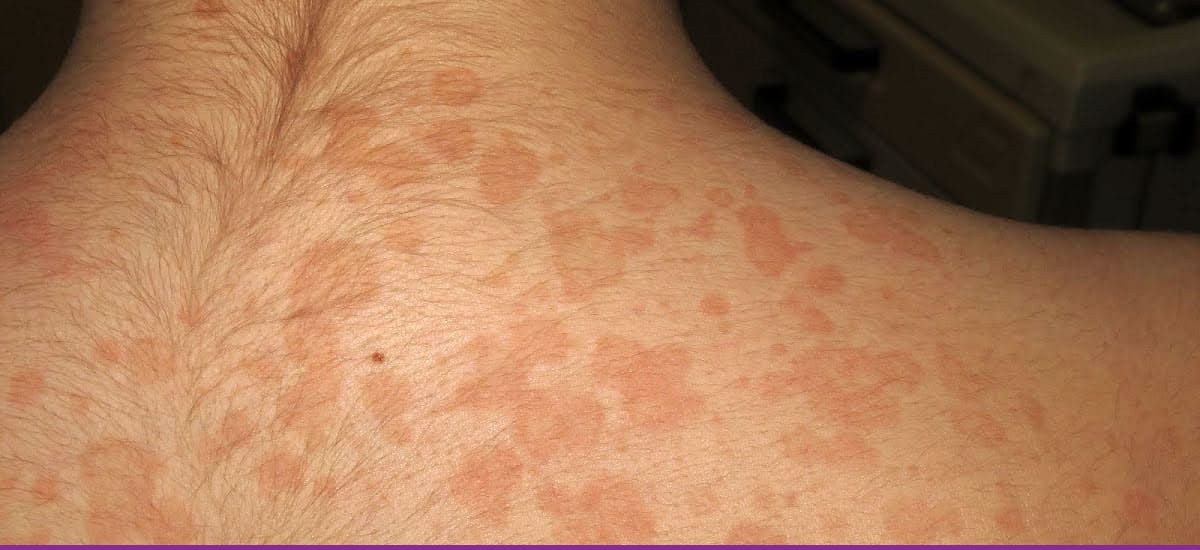Pitiriasis Versicolor