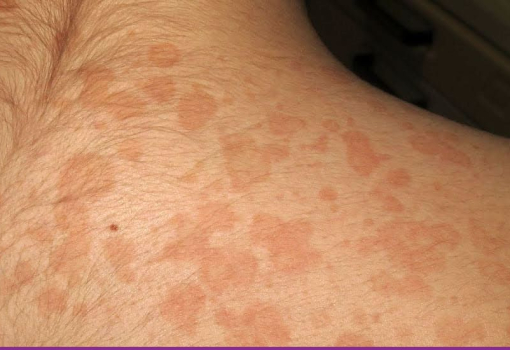 Pitiriasis Versicolor