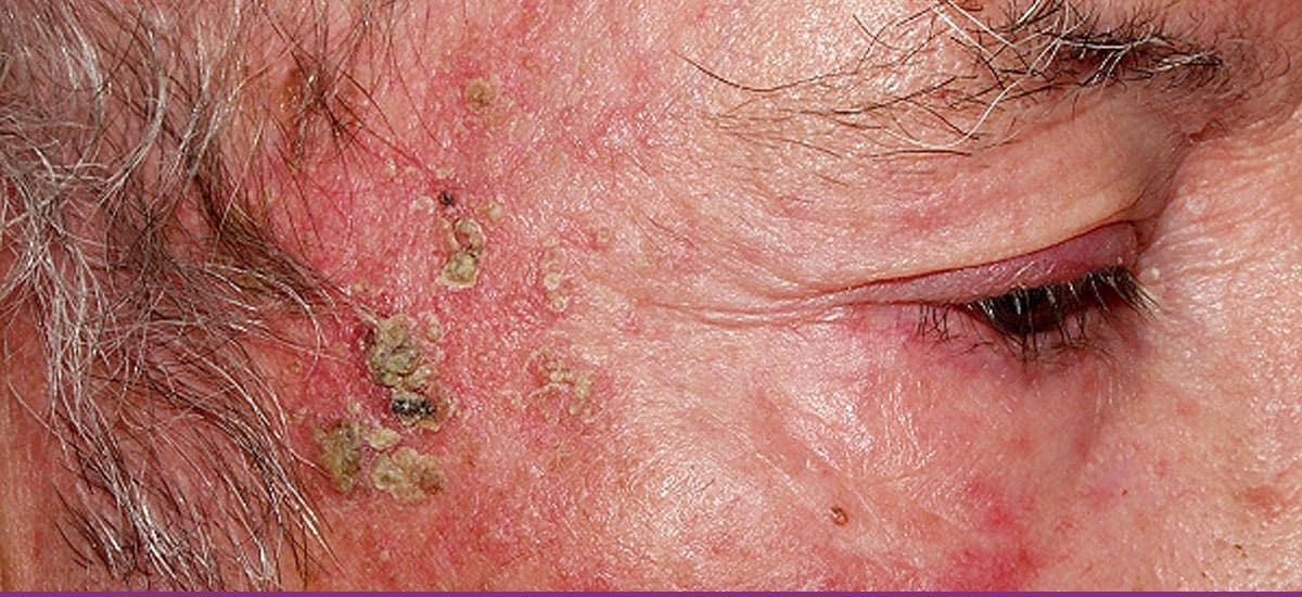 Queratosis Actinicas