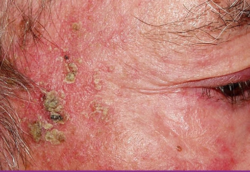 Queratosis Actinicas