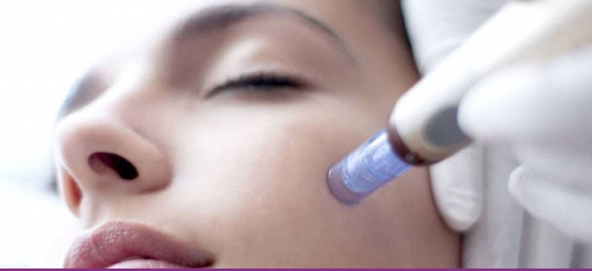 Terapia con Microagujas