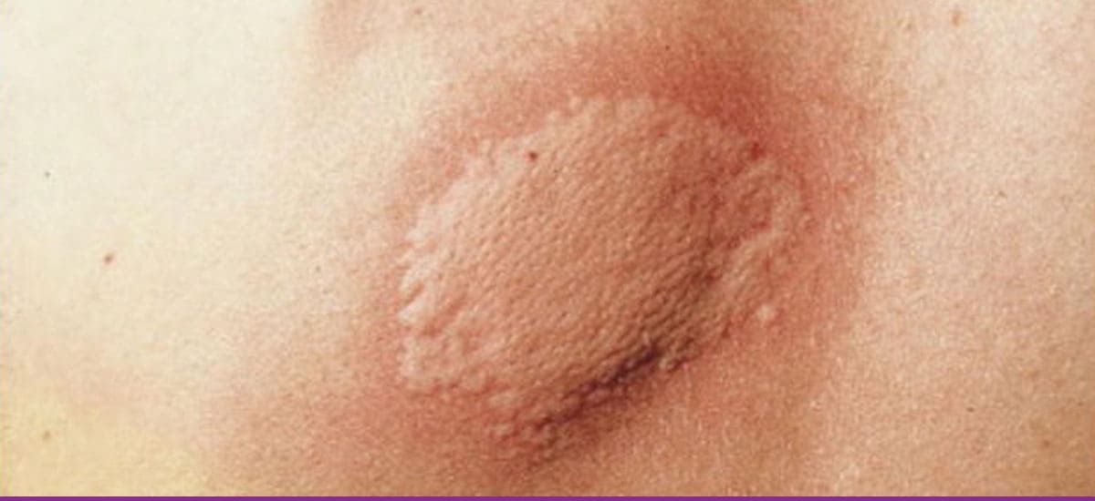 Urticaria Aguda