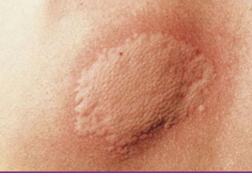 Urticaria Aguda
