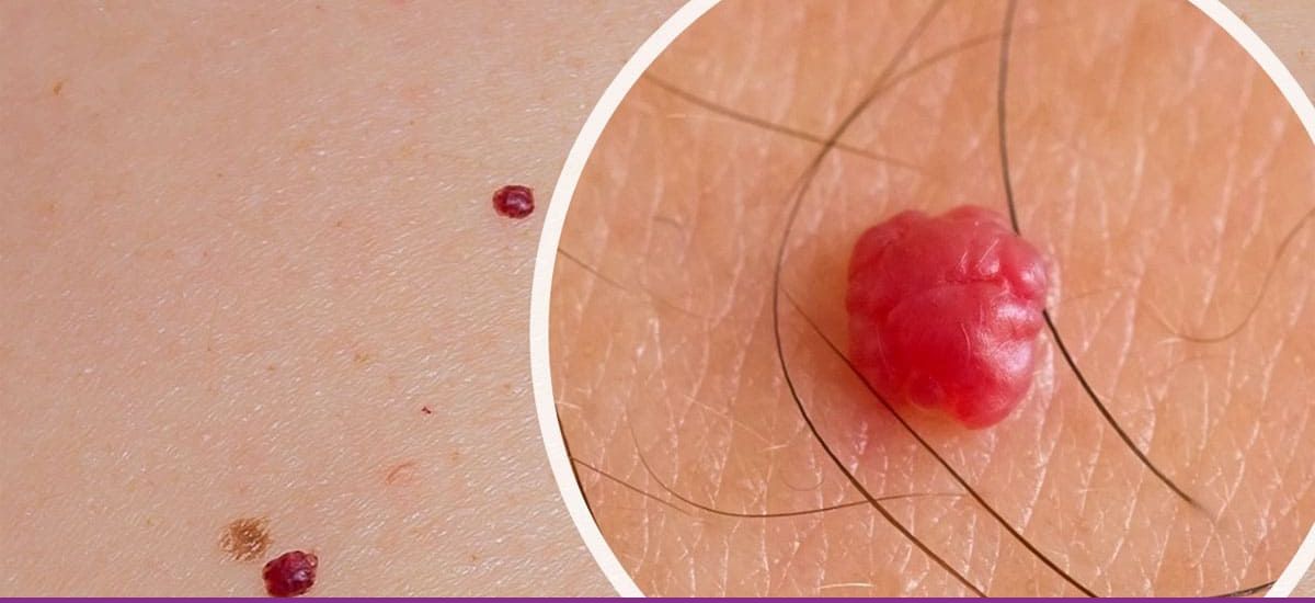 Angiomas Rubí