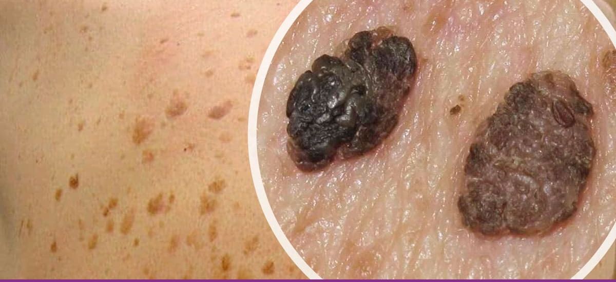 Queratosis Seborréica