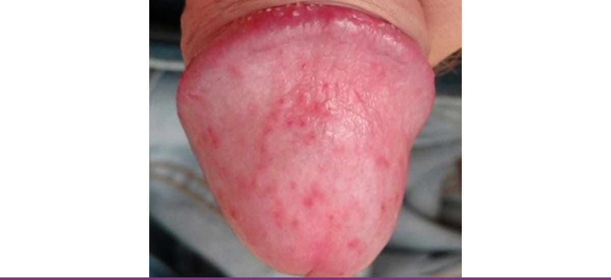 Balanitis