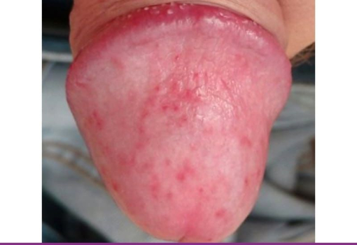 Balanitis