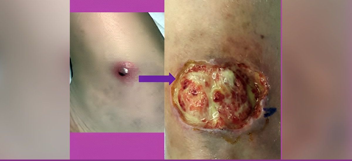 Pioderma Gangrenoso