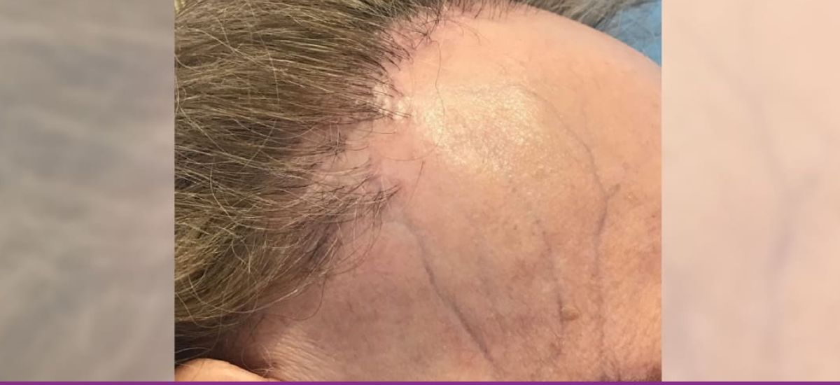 Alopecia Fibrosante Frontal