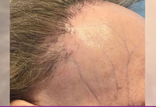 Alopecia Fibrosante Frontal