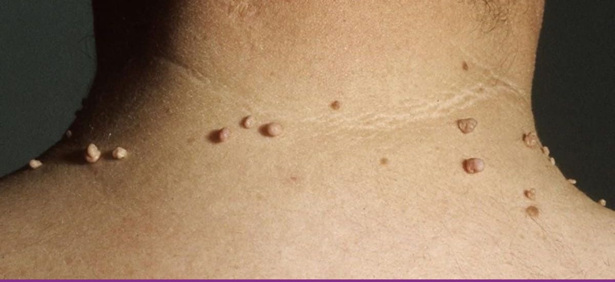 Fibromas Blandos