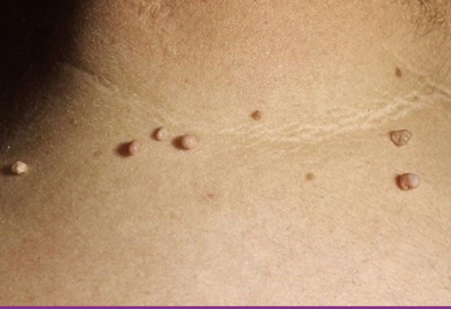 Fibromas Blandos