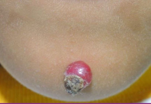 Granuloma Piogeno