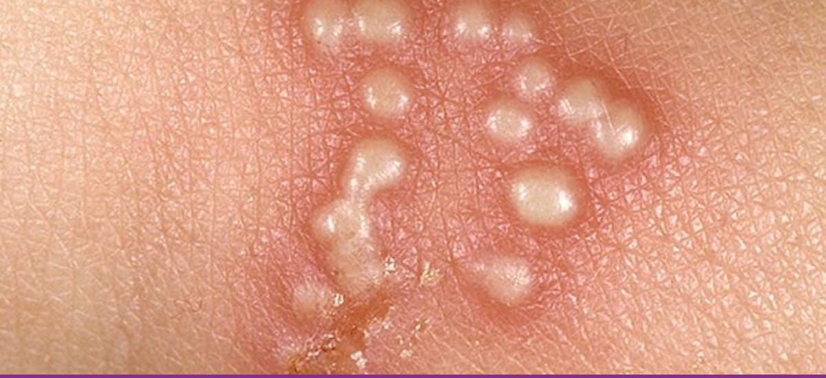 Herpes Genital