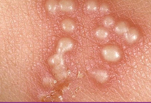 Herpes Genital