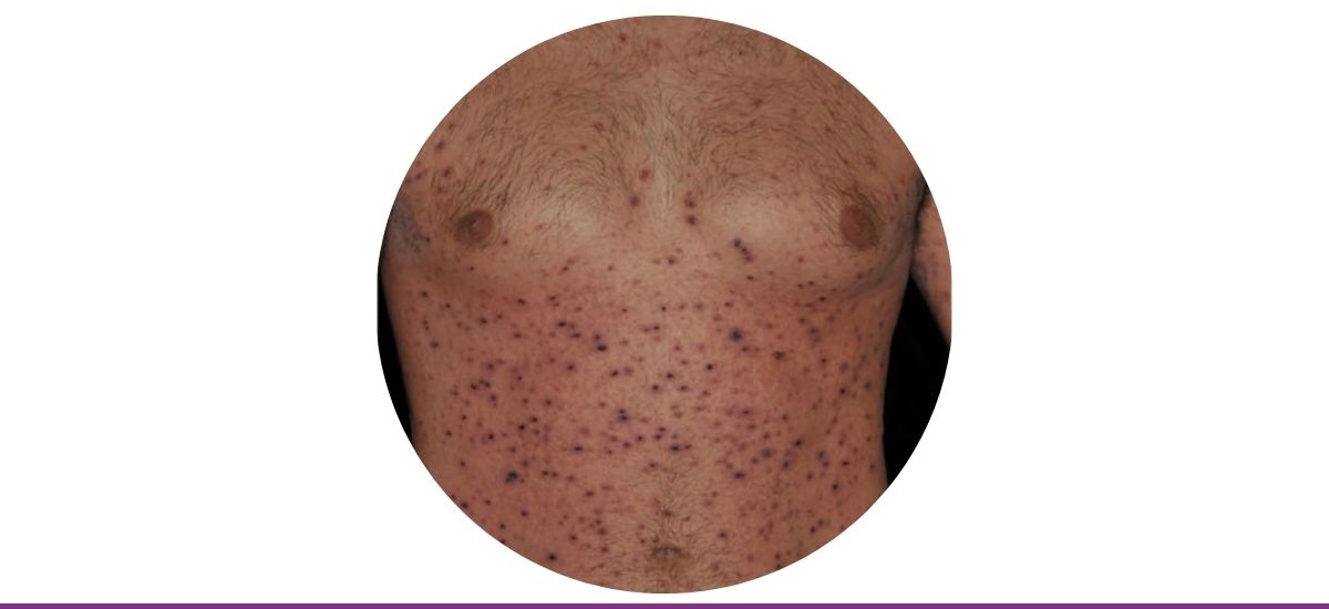 Pitiriasis Liquenoide