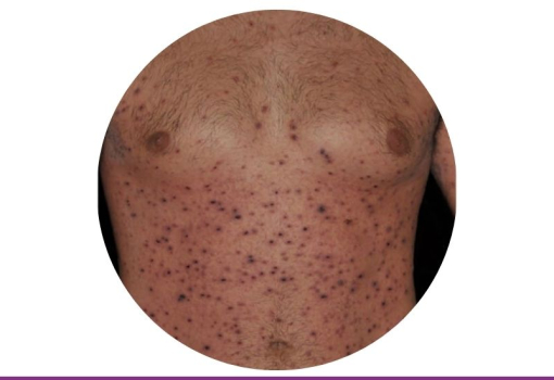 Pitiriasis Liquenoide