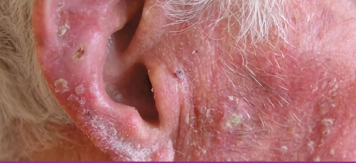 Carcinoma Escamocelular