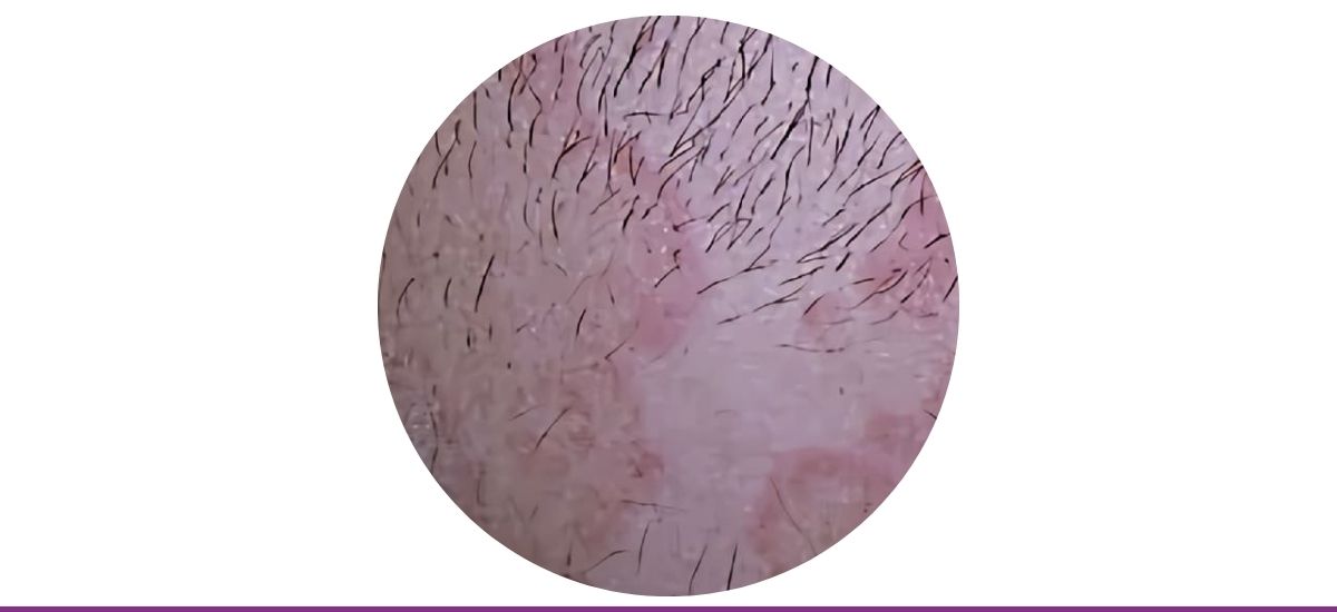 Eritema Anular Centrífugo