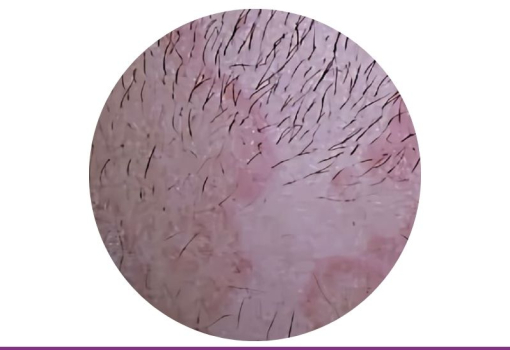Eritema Anular Centrífugo