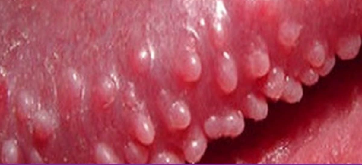 Pápulas Perladas del Pene