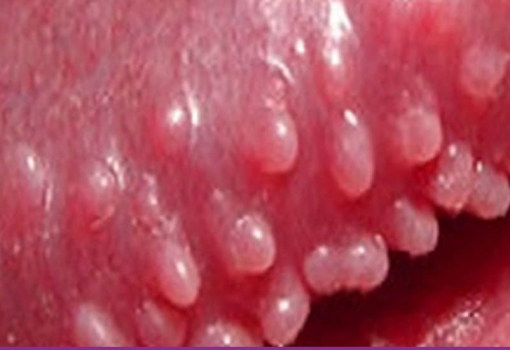 Pápulas Perladas del Pene