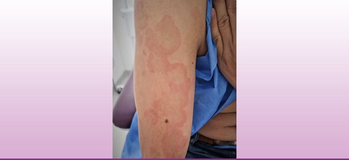 Urticaria Vasculitis