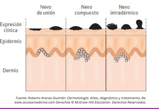 Nevos comunes