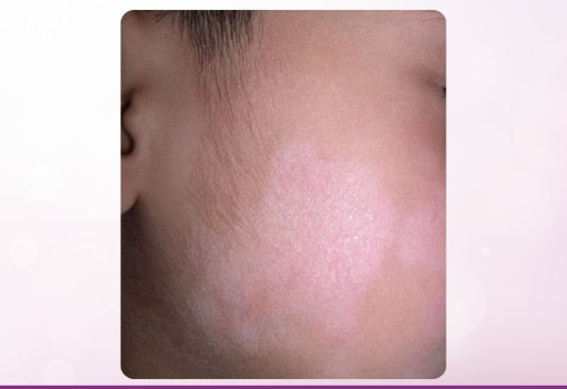 Pitiriasis Alba