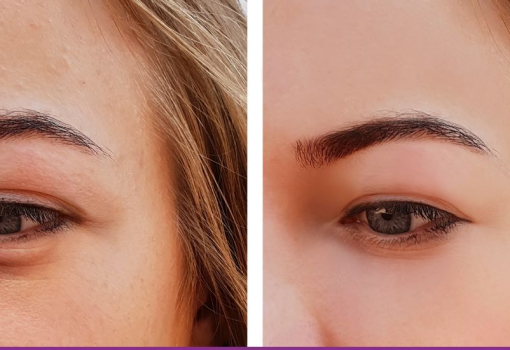 Relleno de Ojeras